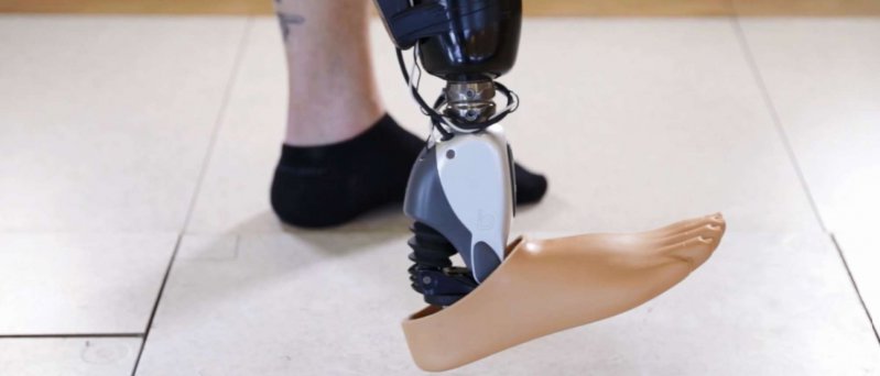 Ossur Sensor Controlled Bionic Foot